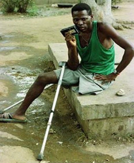 landmine injury, above knee amputation