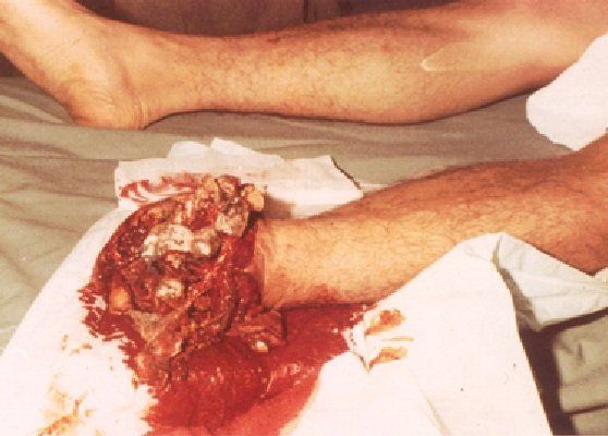 landmine injury, foot and ankle