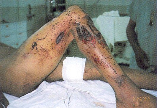 landmine, pattern 2 injury