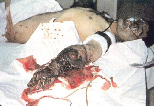 landmine injury, pattern 3, forearm damage