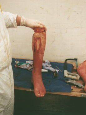 landmine protection boot, amputated human limb