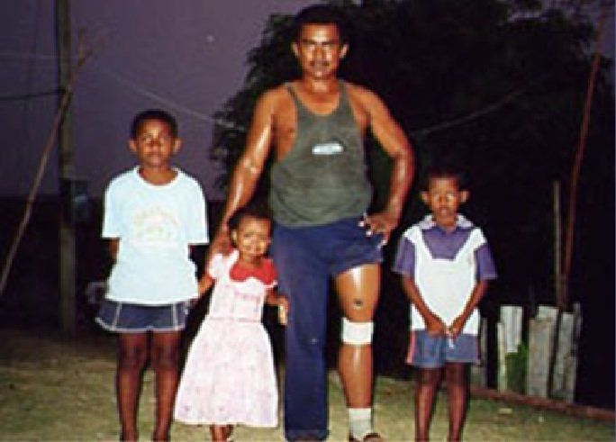 landmine injury, prosthetic leg