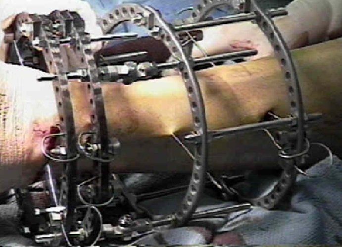 Landmine injury, methods of Ilisarov cage