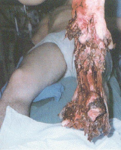 landmine injury, lower leg tissue damage