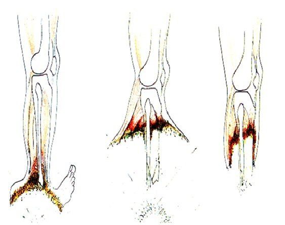 landmine injury, pattern 1 wound