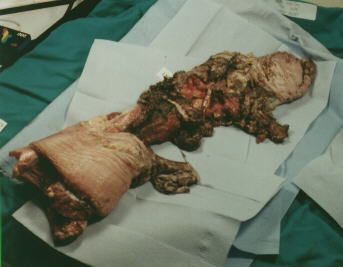 human leg, landmine test, blast research