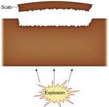 Rear face scabbing from blast